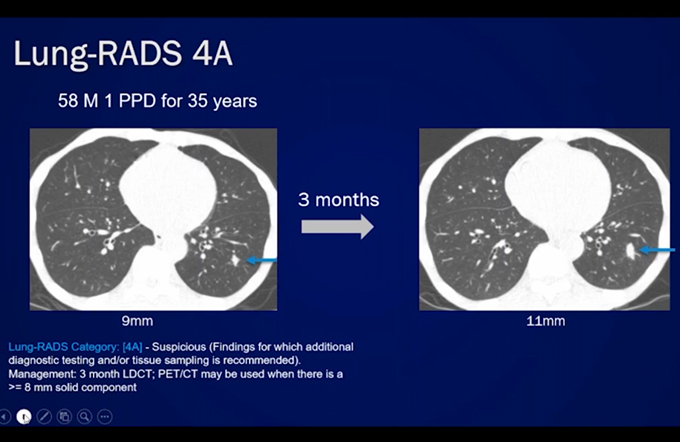 Lung Cancer Screening