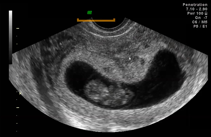 usg-for-bleeding-in-first-trimester-part-i