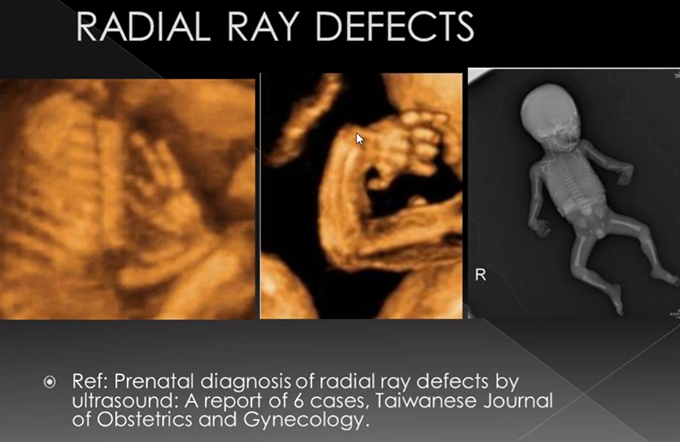 Prenatal Evaluation Of Fetal Limb Anomalies