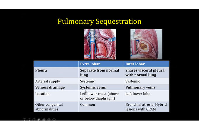 Congenital Lung Disease in Adults