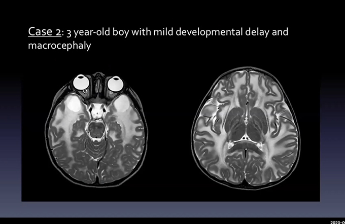 Pediatric brain, Brain tumors, Stroke